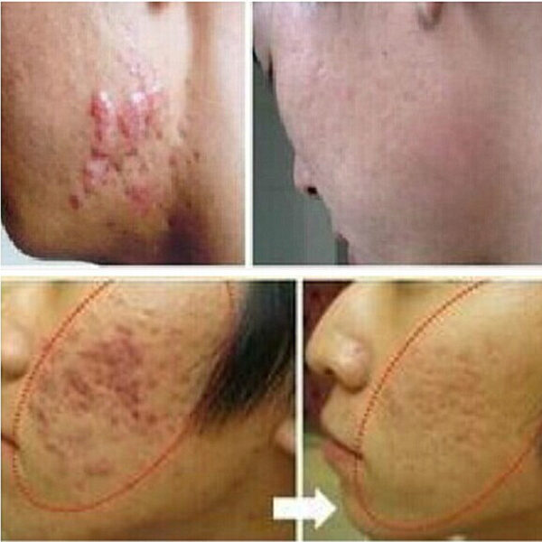 LANBENA-ginseng-extrakt-mot-svart-punkter-cream-ärr-borttagning ansikts-blackhead-acne-hud-vård-behandlings blekning-1.jpg