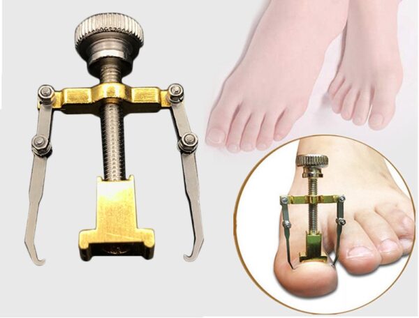 Unhas dos pés encravadas-Pedicure-Ferramentas-de-unhas-para-pés-Arquivo-para-os-pés-ortóticos-Acronyx-Unhas-encravadas-em-joanete (1)