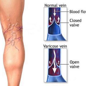 Varicose Veins Treatment Cream - image 4