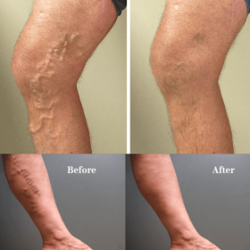 Varicose Veins Treatment Cream - image 2