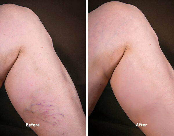 vca before and after sclerotherapy