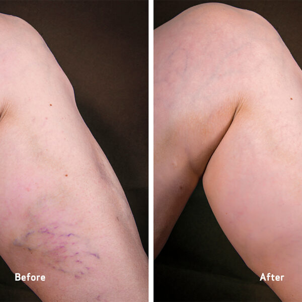 vca before and after sclerotherapy