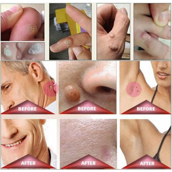 100 Effektiv hudmerkefjerner Naturlig helse Mole Nevus Vorte Fjerning av hudmerker Fot Mais Vorter 5
