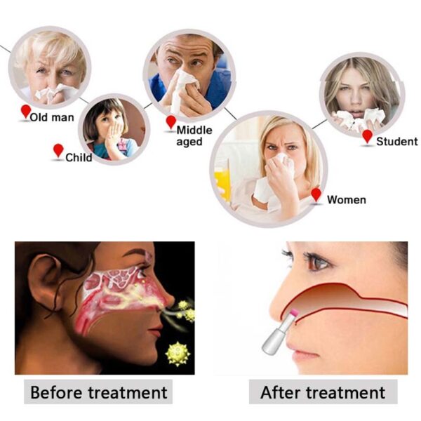 Beurha Proxy BioNase Nose Rhinitis Sinusitis Cure Therapy Massage Hay fever Low Frequency Pulse Laser Nose 1