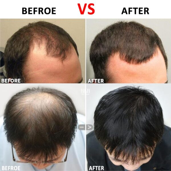 Hair Regrowth Micro needling Roller Beard Growth Product Anti Hair Loss Treatment Thinning Hair Receding Hairline 2