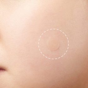 Skin Tag and Acne Patches - image 6