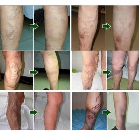 Varicose Veins Herbal Healing Patch - image 2