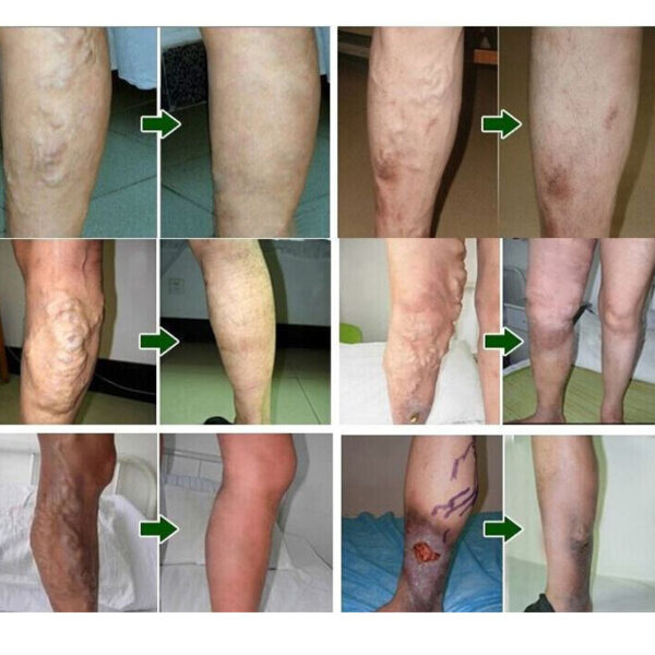 18pcs Varicose Veins Cure Patch Vasculitis Natural Solution Chinese Herbal Treatment Mai Guan Yan Acid Bilges 4