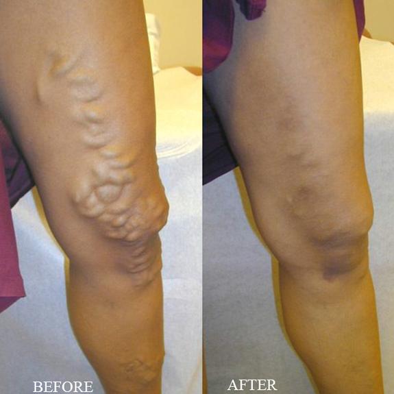 semne de tratament pentru picioarele varicoase