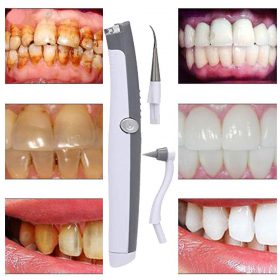 Electric Ultrasonic Tooth Stain Eraser - image 3