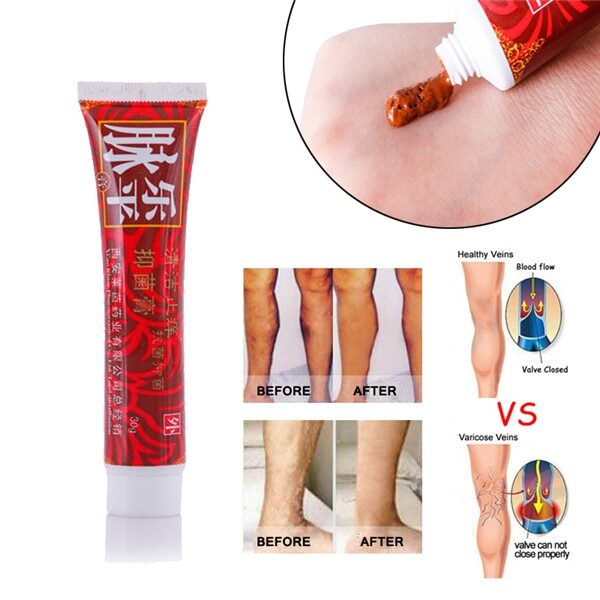 Varicose Veins Treatment Cream Ointment Vasculitis Phlebitis Spider Veins Pain Varicosity Angiitis Remedy Removal Herbal Cream 2