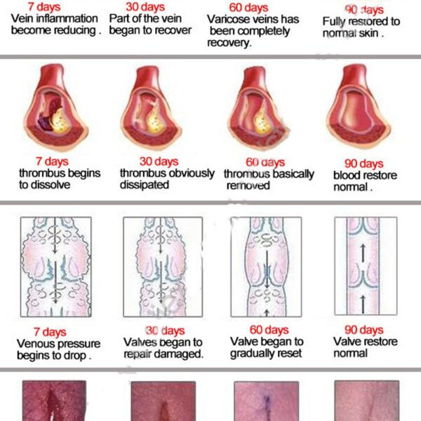 Varicose Veins Treatment Cream Ointment Vasculitis Phlebitis Spider Veins Pain Varicosity Angiitis Remedy Removal Herbal Cream 5