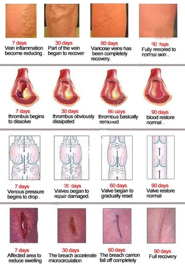 Varicose Veins Treatment Cream Ointment Vasculitis Phlebitis Spider Veins Sakit Varicosity Angiitis Remedy Pagtangtang Herbal Cream 5