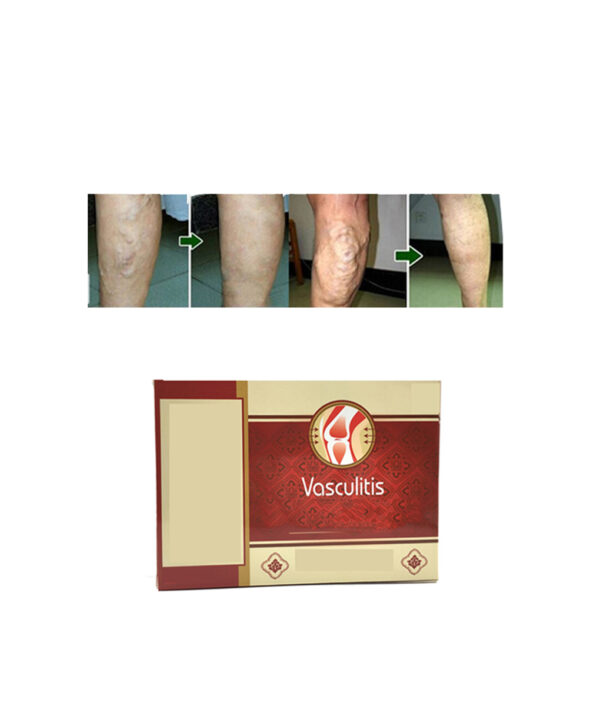 18pcs Varicose Veins Cure Patch Vasculitis طبیعي حل د چینایي بوټو درملنه Mai Guan Yan Acid Bilges 5 1 1