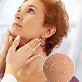 Skin Tag Remover - image 2