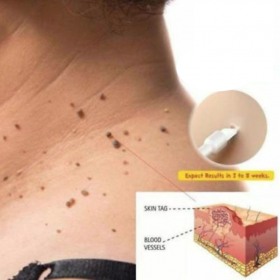 Skin Tag Remover - image 3