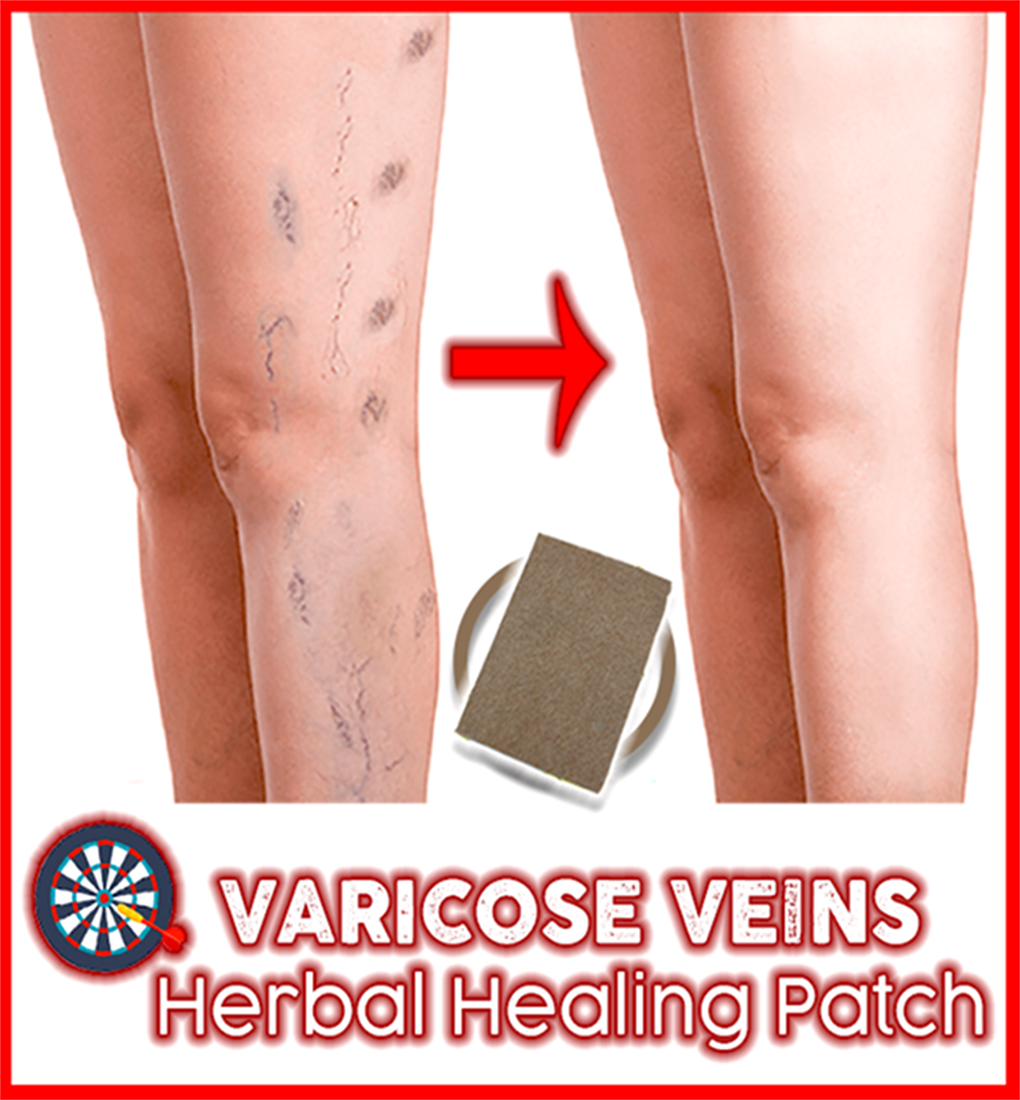 Cum de a vindeca venele varicoase pe picioare. Cum Se Vindecă Venele Păianjen
