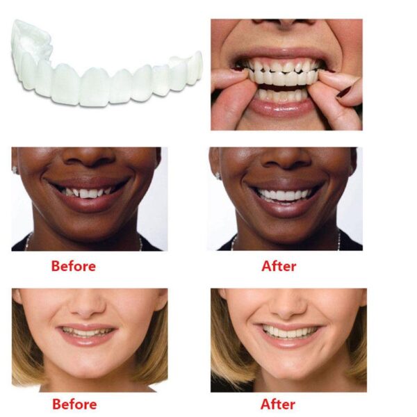 XY فینسی دانت سفید کرنے والے دانتوں کا احاطہ کامل مسکراہٹ آرام فٹ فلیکس دانت ونیرس 1