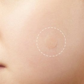 36pcs Skin Tag Remover Patch - image 3