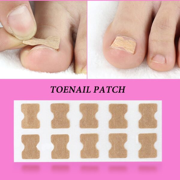 Ingrown Toenail Corrector Sticker Paronychia Treatment Fixer Recover Corrector Pedicure Foot Toe Nail Care Tool Glue 1