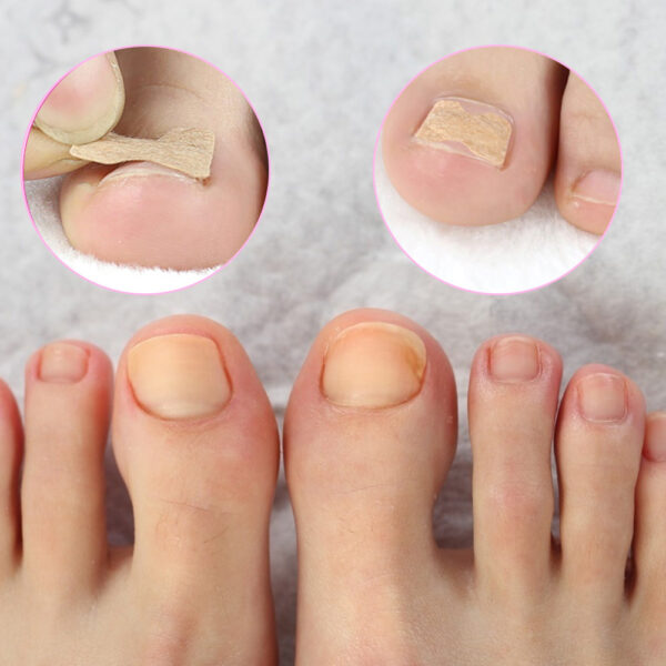 Ingrown Toenail Corrector Sticker Paronychia Treatment Fixer Recover Corrector Pedicure Foot Toe Nail Care Tool Glue 4