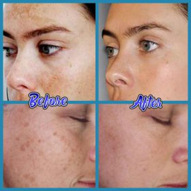 Anti-Blemish Facial Cream - image 5