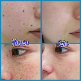 Anti-Blemish Facial Cream - image 7