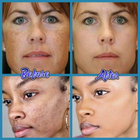 Anti-Blemish Facial Cream - image 3