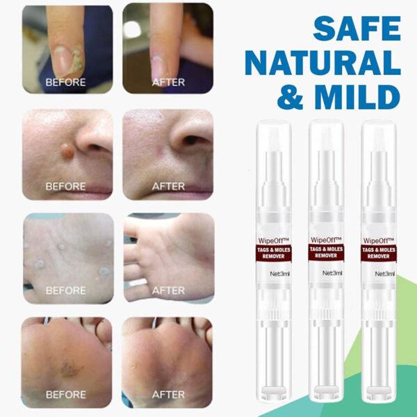 Pagpahid sa Tag Moles Remover 3ml Skin Tags Mole Remover Epektibo nga Pormula para sa Pagtangtang sa Skin Tag 2