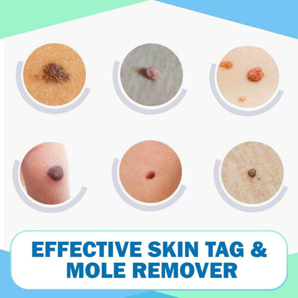 Pagpahid sa Tag Moles Remover 3ml Skin Tags Mole Remover Epektibo nga Pormula para sa Pagtangtang sa Skin Tag 4