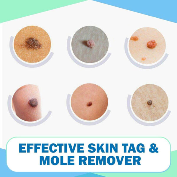 Mu ese kuro Tags Awọn imularada Moles 3ml Awọ Awọn afi afi Mole Imukuro Imudara Daradara fun Awọ Awọn aami Awọ