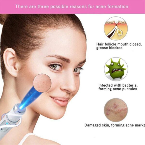 Blue Light Therapy Varicose Veins Treatment Laser Pen Soft Scar Wrinkle Removal Treatment Acne Laser Pen 1