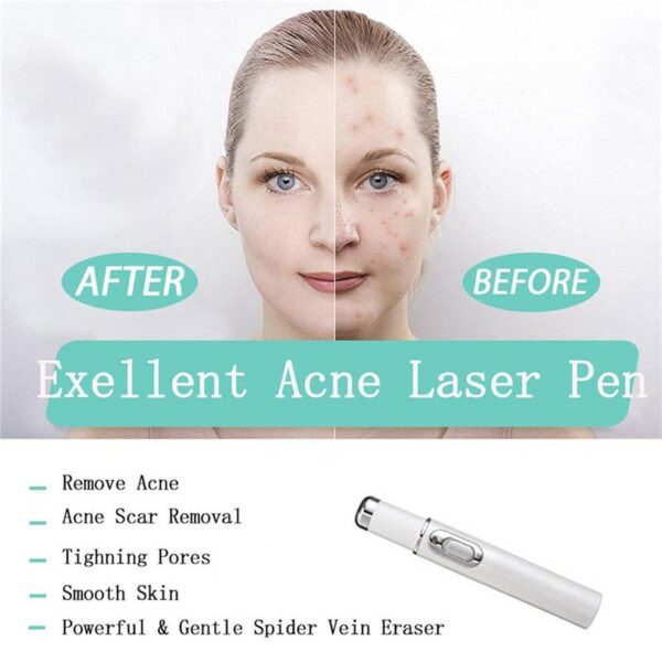 Caneta laser para tratamento de varizes, terapia de luz azul, remoção macia de cicatrizes, acne, caneta laser 4