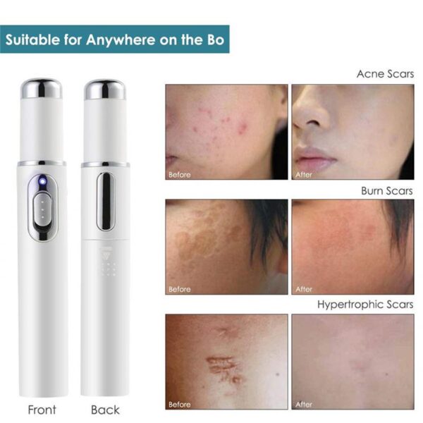 Terapi Cahya Biru Perawatan Varises Vena Laser Pena Soft Scar Wrinkle Pengobatan Pen Laser Jerawat