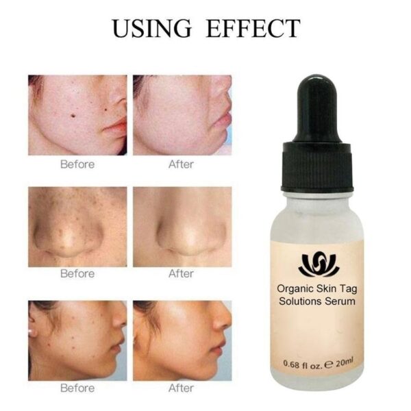 Organic Tags Solutions Serum တွင် Painless Mole Skin Dark Spot Removal Serum Face Wart Tag တင်းတိပ်များကို ဖယ်ရှားခြင်း 2