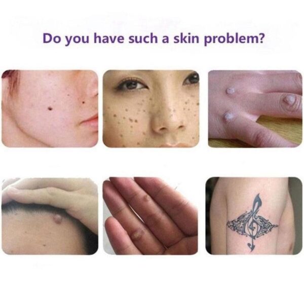Fuasglaidhean Tagaichean organach Serum Painless Mole Skin Dark Spot Removal Serum Face Wart Tag Freckle Removal 3