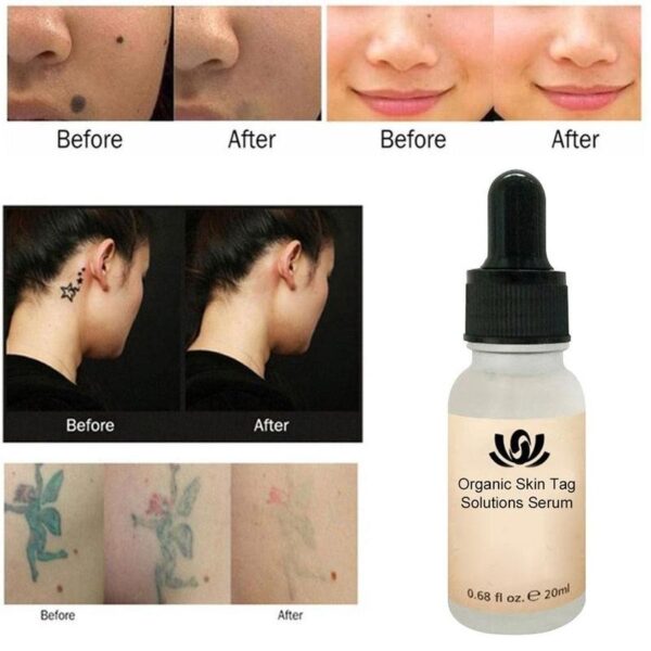 Organic Tags Solutions Serum Painless Mole Skin Dark Spot Removal Serum Face Wart Tag Freckle Removal 4