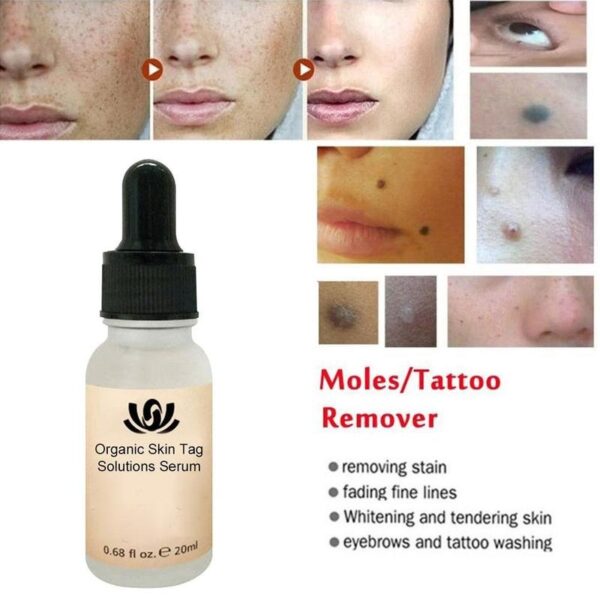 Organic Tags Solutions Serum Painless Mole Skin Dark Spot Removal Serum Face Wart Tag Freckle Removal 5