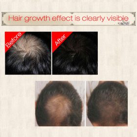 Hair Regrowth Essence Intensive Spray - image 5