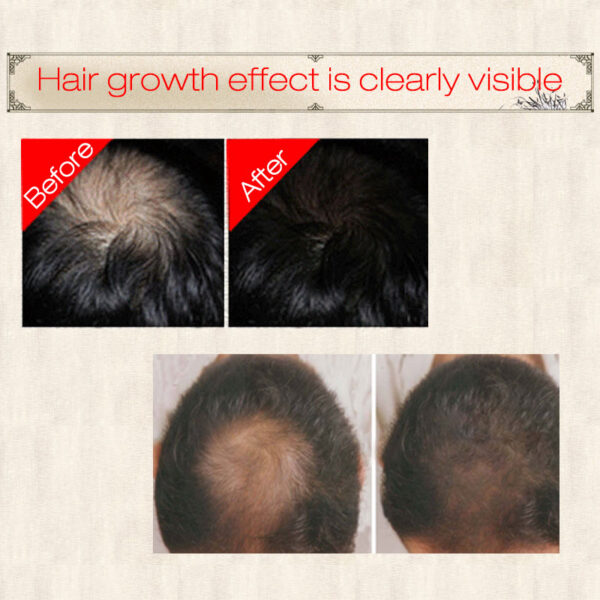 Sevich 30ml Hebal Essence Fast Hair Growth Spray ဆံပင်ကျွတ်ခြင်း ကုသခြင်း ဆံပင် ကြီးထွားမှုအတွက် အကူအညီ 4