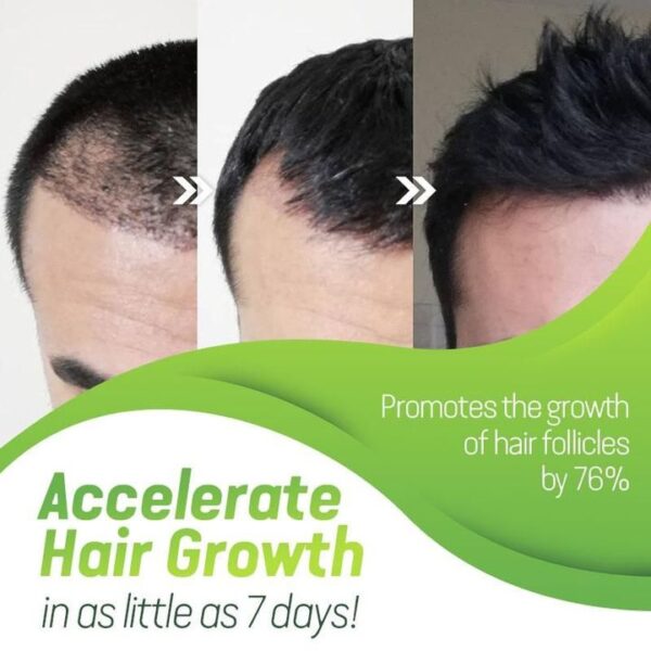 1pc 7X Rapid Growth Hair Treatment Anti Hair Loss Fast Hair Growth Serum Ginger Essential Oil 2