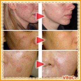 VC Whitening Freckle Serum - image 6