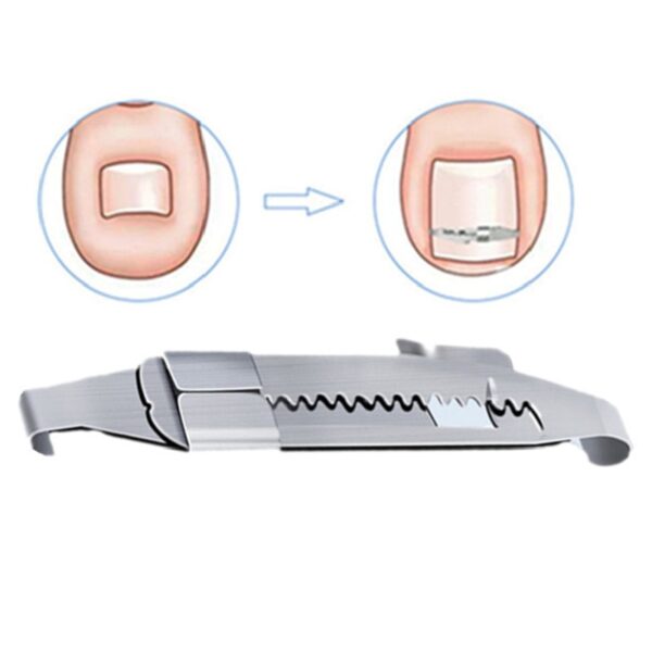 Ingrown toenail corrector Tools Pedicure Recover Embed Toe Nail Treatment professional Ingrown toenail correction Foot Care 3