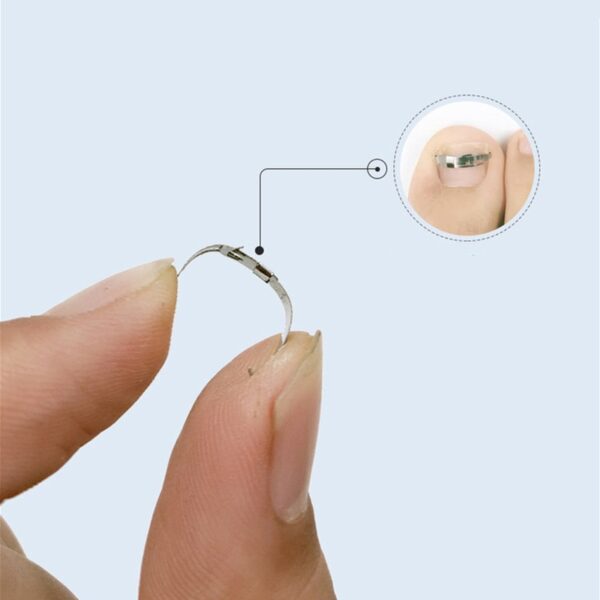Ingrown toenail corrector Tools Pedicure Recover Embed Toe Nail Treatment professional Ingrown toenail correction Foot Care 4