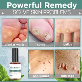 Corn Removal Extra Strengthen Gel - image 7
