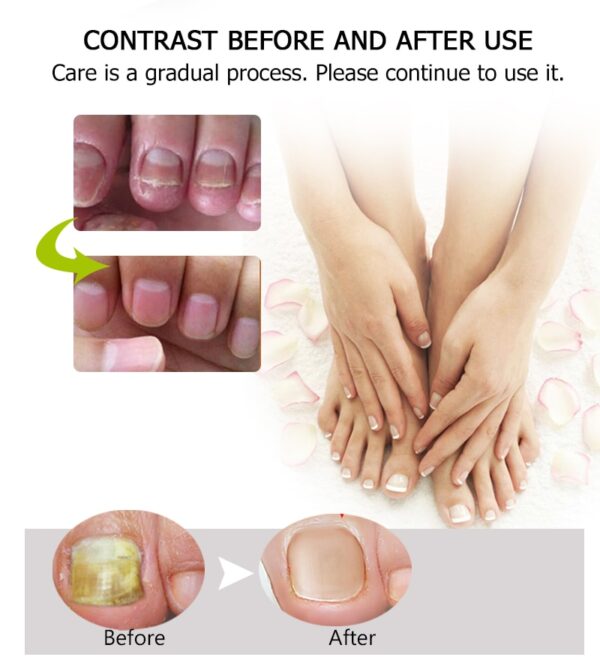 Pieds d'orteils fongiques du traitement des champignons des ongles Anti-Infection fongique pied Anti-inflammatoire Onychomycose ongle d'orteil 1