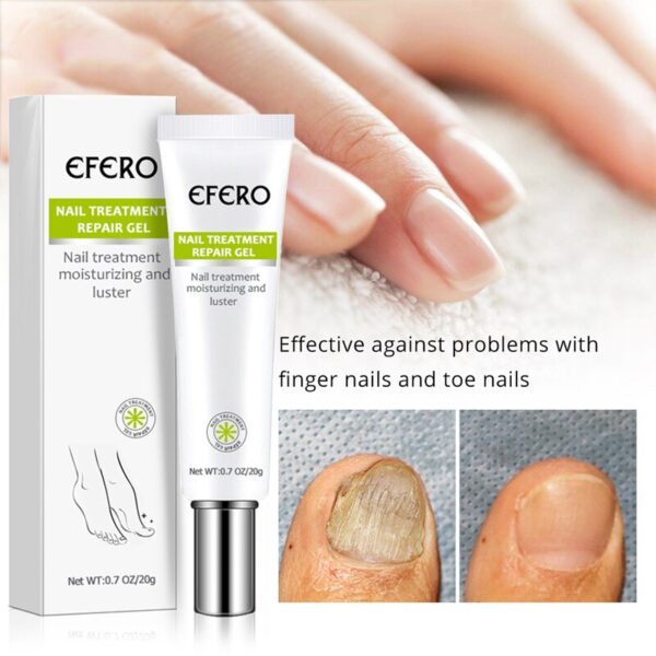 Fungal Toe Feet From Nail Fungus Treatment Anti fungal Infection Foot Anti inflammatory Onychomycosis Toe Nail 3