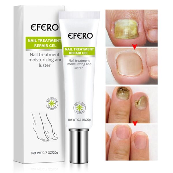 Fungal Toe Feet From Nail Fungus Treatment Anti fungal Infection Foot Anti inflammatory Onychomycosis Toe Nail 4