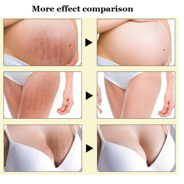 Ifory Skin Care Cream Thailand Pasjel Precious Body Removal Repair Patch Scar Removal Postpartum Obesity Pregnancy 2