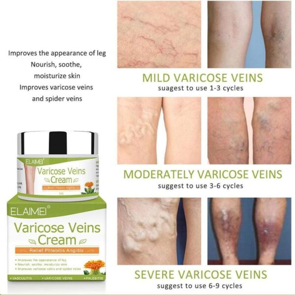 Varicose Veins Ointment 50g Varicosity Angiitis Removal Medical Plaster Vasculitis Phlebitis Spider Cream 5